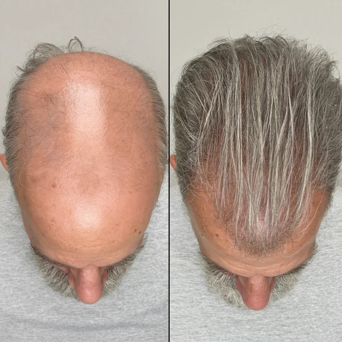 redlume-p4 Antes y despues densidad +55 90 dias