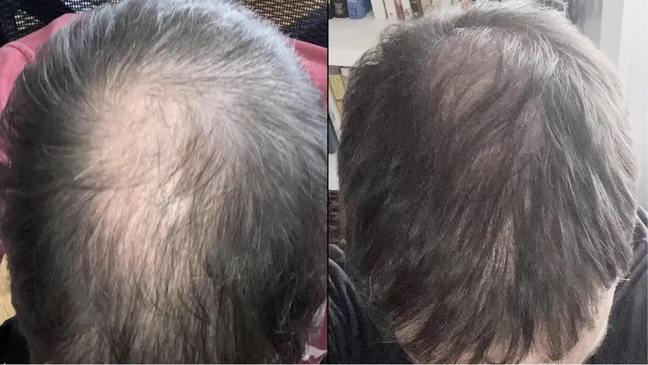 Antes y después con la Gorra RedLume