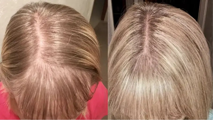 Antes y después con la Gorra RedLume