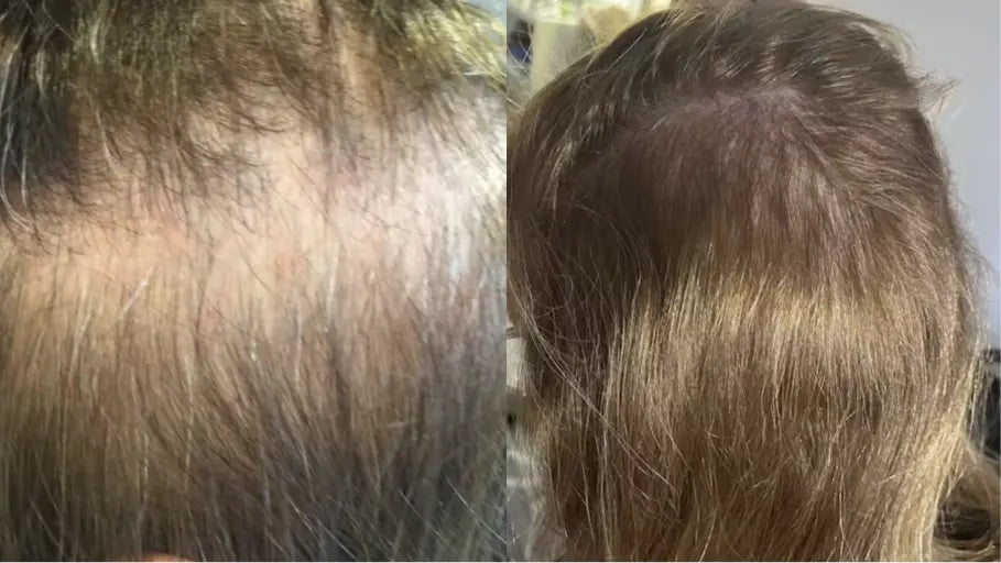Antes y después con la Gorra RedLume