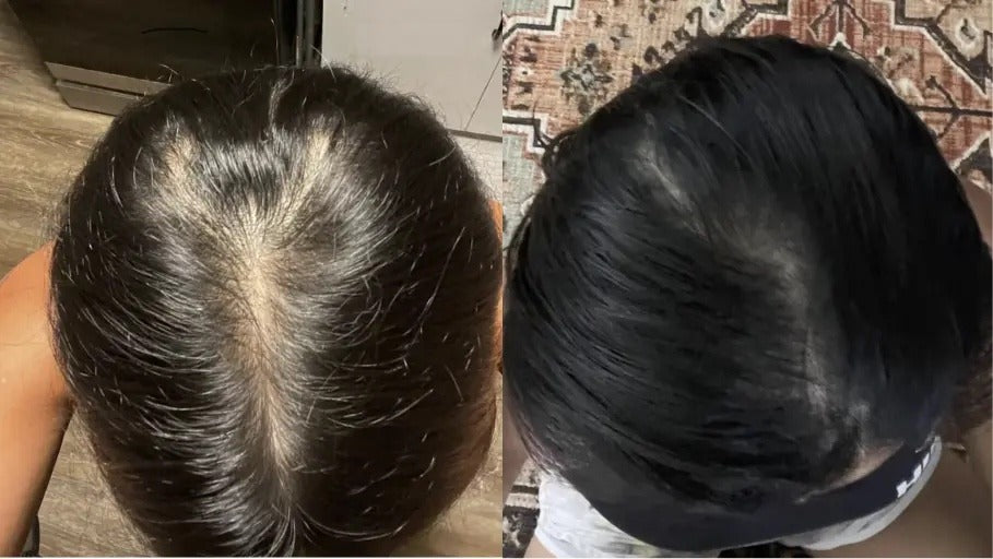 Antes y después con la Gorra RedLume