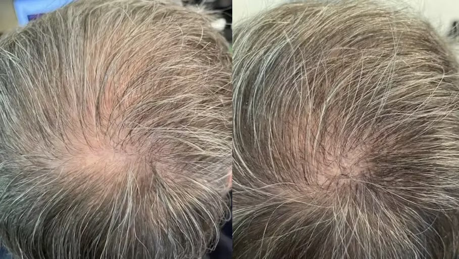 Antes y después con la Gorra RedLume