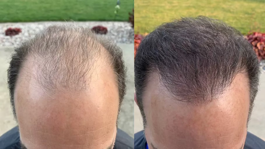 Antes y después con la Gorra RedLume