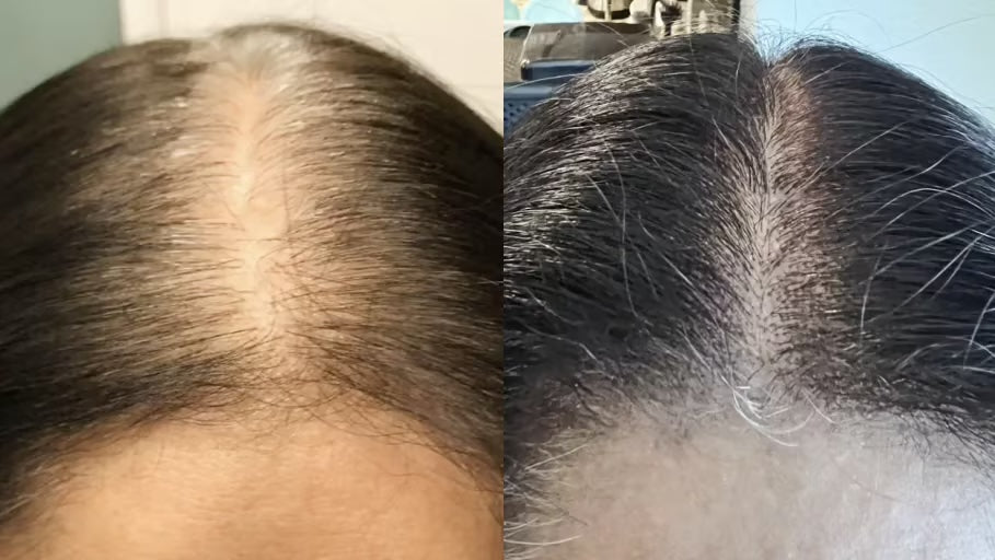 Antes y después con la Gorra RedLume