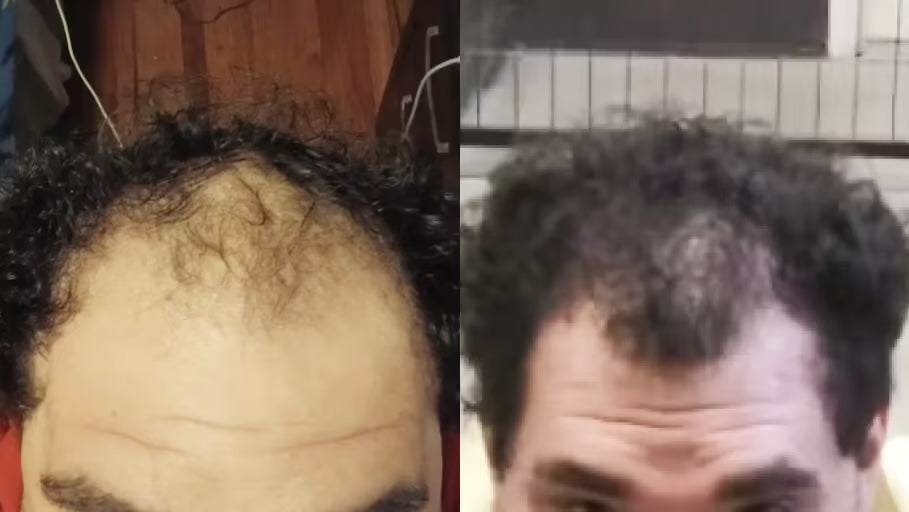 Antes y después con la Gorra RedLume