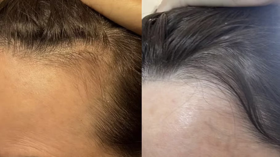 Antes y después con la Gorra RedLume