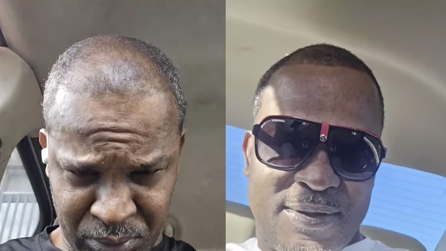 Antes y después con la Gorra RedLume