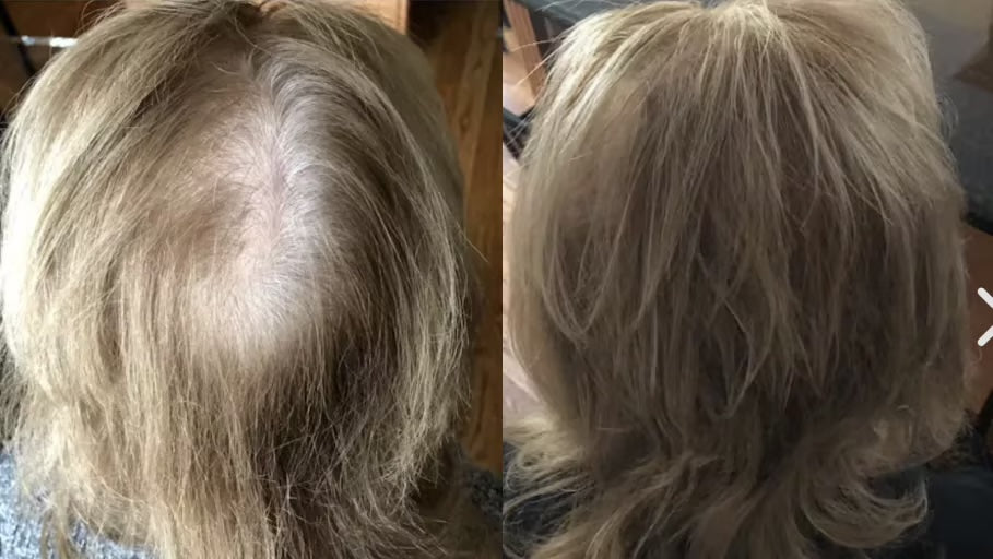 Antes y después con la Gorra RedLume