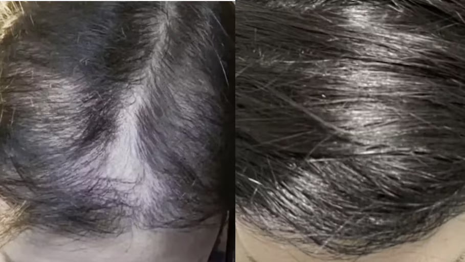 Antes y después con la Gorra RedLume
