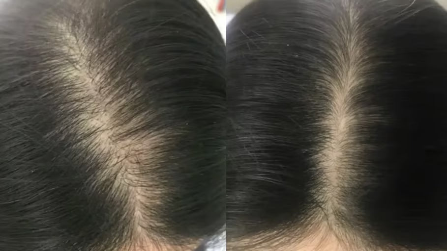 Antes y después con la Gorra RedLume