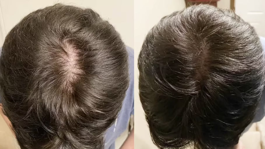 Antes y después con la Gorra RedLume