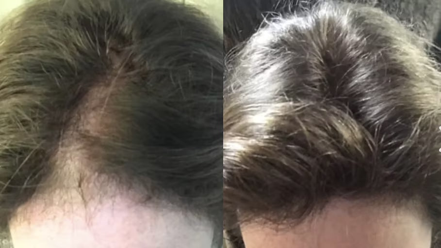 Antes y después con la Gorra RedLume