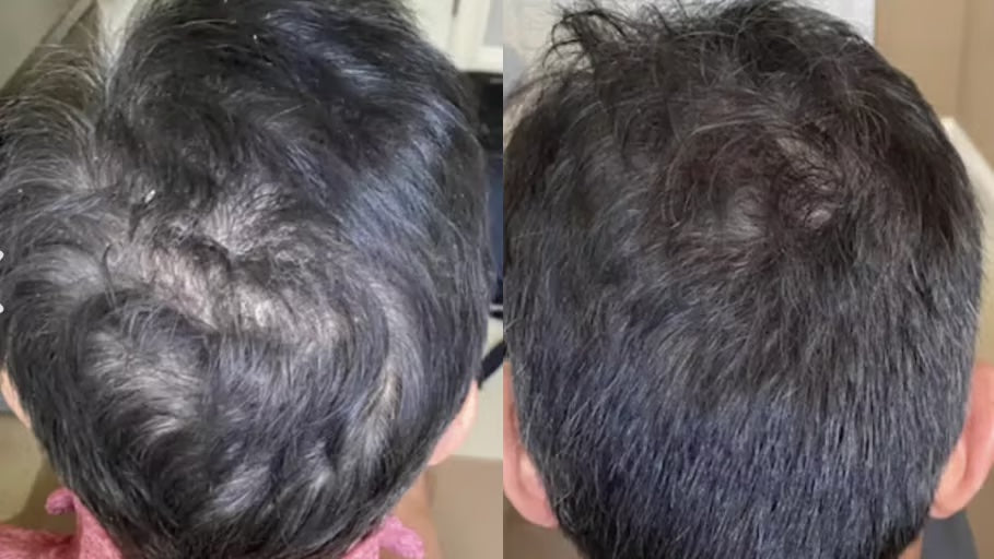Antes y después con la Gorra RedLume